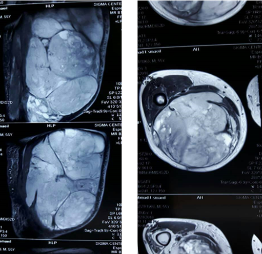 Limb salvage surgery: A case report of large thigh liposarcoma