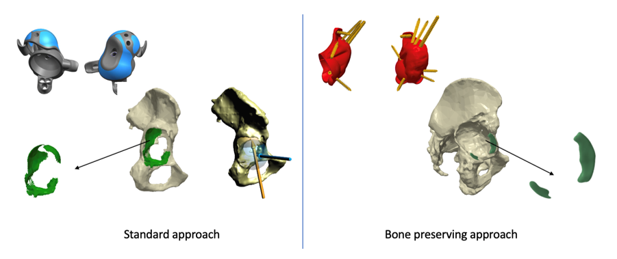 Bone Pressed Approach Advancing custom implant design: A bone-preserving, patient-specific ...