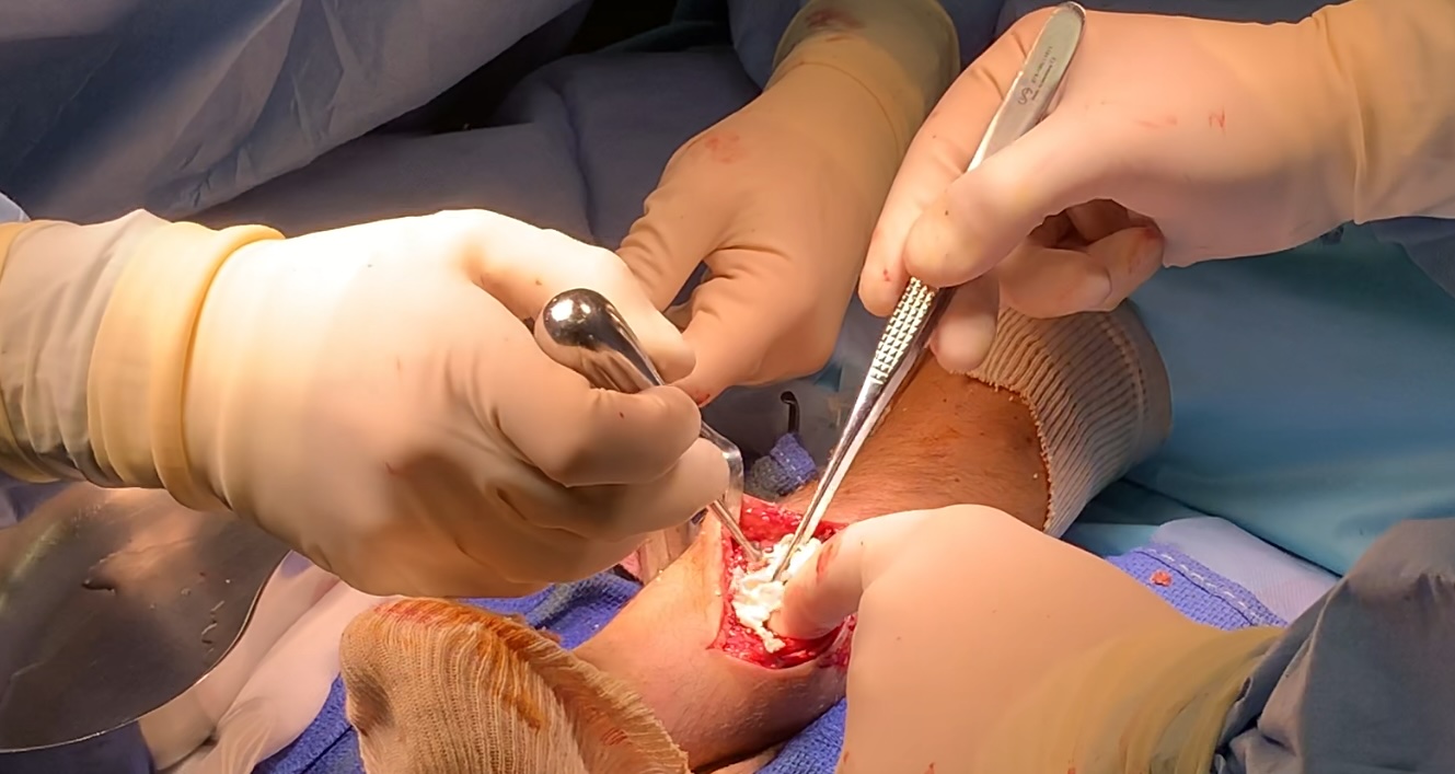 Novadip recruits first pediatric patients in pivotal phase 3 trial of tissue regenerative treatment