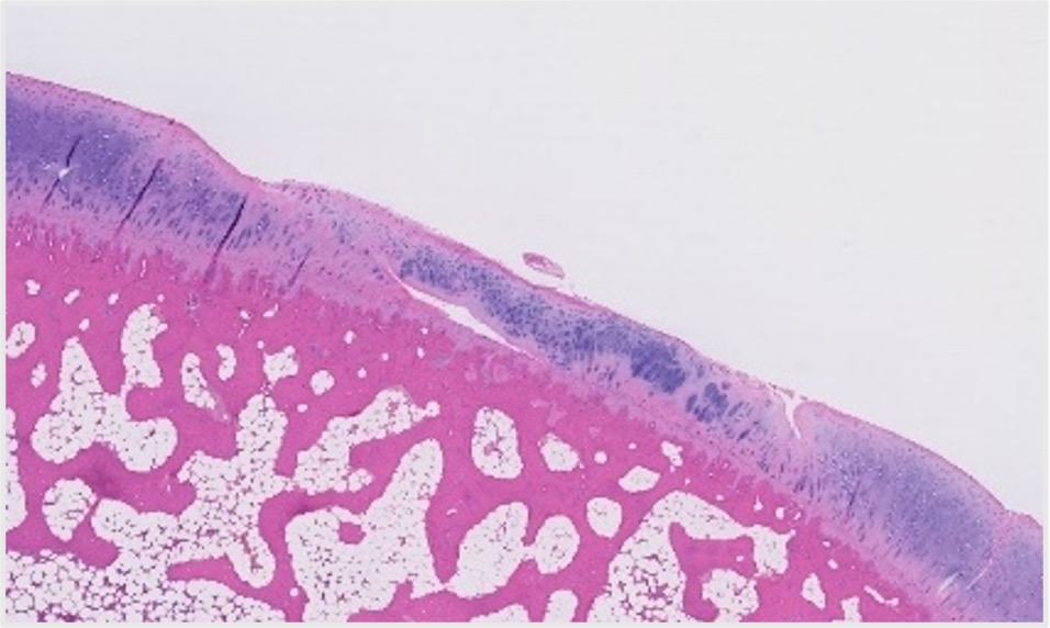 New study – Can gum cells cure knee arthritis?