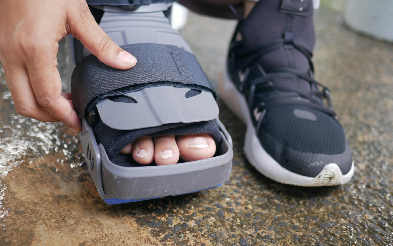 Six weeks in a cast no less effective than surgery for unstable ankle fractures